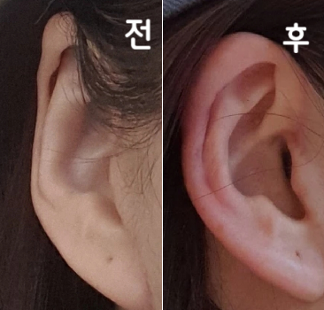 원장님이 아주 꼼꼼하게 놓아주셔서 정말 감사드려용~~