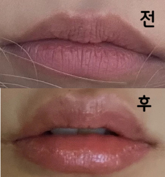윗송곳니 한 쪽이 덧니라 입술이 비대칭인데 그것도 신경써서 필러양 조절해주셔서 좋았어요!