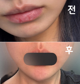 남자친구가 처음 하기 전엔 탐탁치않아했는데 1일차 당일부터 엄청 이쁘게 잘 됐다고 리즈라고 하더라구요 ㅋㅋㅋ
