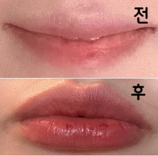 스탭분들과 의사선생님 너무너무 친절하셨어용 리터치도 받을 수 있어서 너무 가성비 짱이고용!