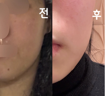얼굴에 살이 많기도 했고 얼굴이랑 목이 분리되지 않는 느낌이라 함 해봤어요!