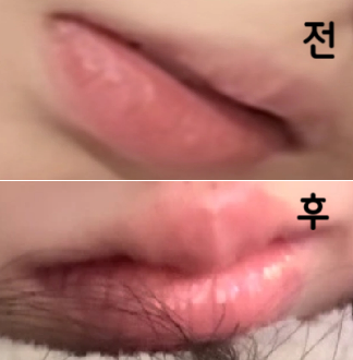 입꼬리 보톡스 추가로 맞았습니당 엄청 쫄보라 무서웠는데 맞고 너무 너무 만족하고 있어요!!