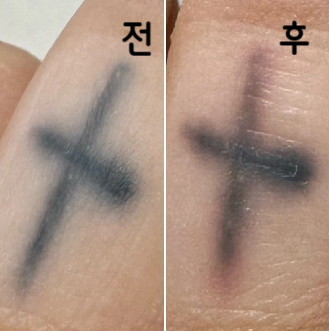 너무너무 아팠지만 수술방 선생님과 원장님이 계속 말 걸어주시고 다른 부위 하는동안 아이스팩 계속 올려주셔서 너무 감사했어요 ㅠ