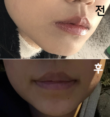 두 번째 시술인데 꼼꼼히 아픈지 계속 물어봐주시고 좋았습니다!!