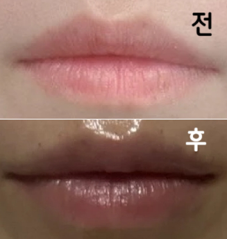 대기가 길었지만 시술 후 너무 만족해서 괜찮았어요
