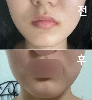 시술 5일차인데 어느정도 효과 있는 것 같아요!!