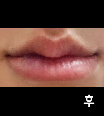 여러병원 고민하다 후기 좋아서 이 곳 선택했는데 너무 만족해요 ㅠㅠ ♥