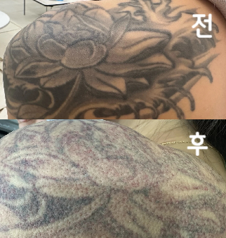 문신제거 항상 꼼꼼하게 잘 해주시고 직원분들도 다 친절했어요~