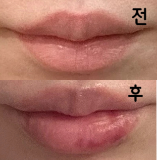 쥬비덤 총 3cc 넣었는데 결과는 대만족입니다!!