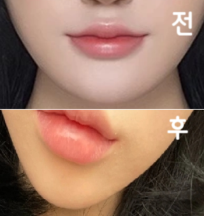매번 갈 때마다 간호사 선생님들도 엄청 친절하시고 효과도 좋았어용 다들 강추!