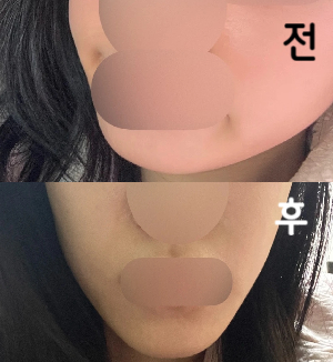 비용이 합리적이고 효과가 이틀만에 바로 나타나서 너무 좋아용~