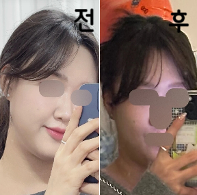 2회차는 스테로이드 있는 걸로 맞았는데 다음날 바로 효과 나타나요!!!