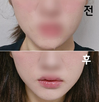 이번엔 스테로이드 있는걸로 맞았는데 역시 효과가 바로 나타나네요 ㅎㅎ 여느때와 같이 친절하셨습니당~~