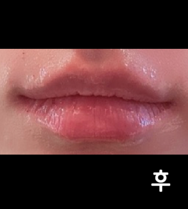 업셀링 없이 필요한 부분과 원하는 디자인 상담 후에 오랜 대기없이 시술 할 수 있어 좋았어요