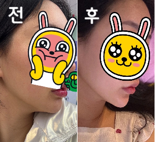 포키주사 처음 맞아보는데 세 번 맞아야 효과가 좋을 거라고 하셨는데 한 번만에도 벌써 갸름해졌어요~!