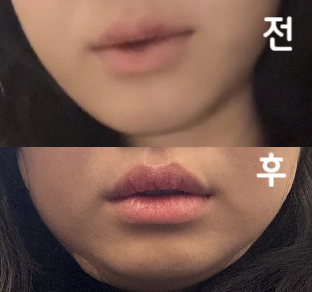 여자 원장님께서 시술 해 주셨는데 너무 친절하시고 관리법도 잘 알려주셔서 도움이 많이 된 것 같아요!