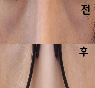 다운타임이 없는 것이 좋아 우연히 발견한 울트라콜! 눈 밑에 탄력이 나서 대만족이에요!!