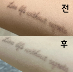 갈 때마다 항상 친절하게 해주시고 토요일이라 기다리는 사람들이 많았는데 생각보다 엄청 빨리 시술 받았어요~