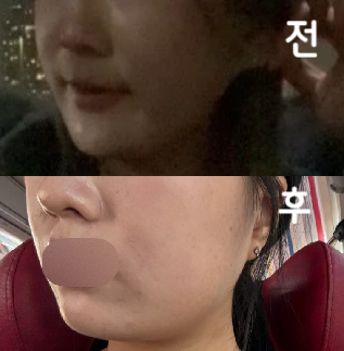 평소에 얼굴 살이 너무 많아서 ㅠㅠ 볼 살 좀 없애러 갔습니다!!