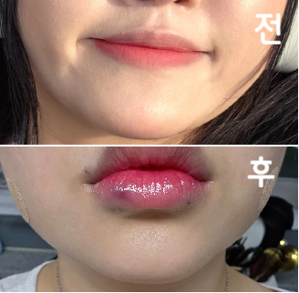 꾸준히 맞고 있어서 효과는 있는 것 같구 많이 안 아파서 주기적으로 맞고 있어용!