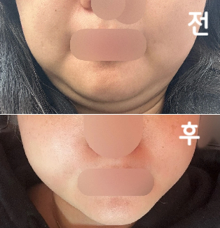 되게 친절하시구 진짜 턱살도 볼살도 많이 없어진 거 같아요!! 효과 굿굿!!