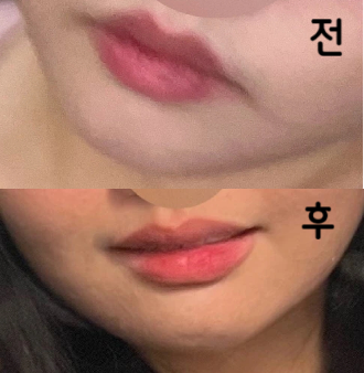 윤곽주사 알아보다가 후기도 많고 유명한 것 같아서 선택했는데 가장 만족스러웠어요!