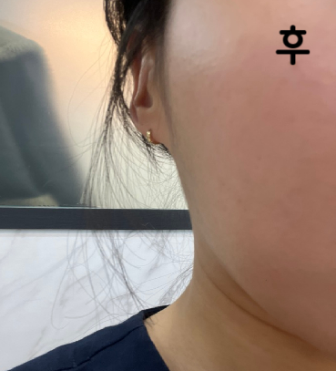 원장님이 얼굴 상태 보시고 꼼꼼하게 시술 해 주셔서 좋았어요~