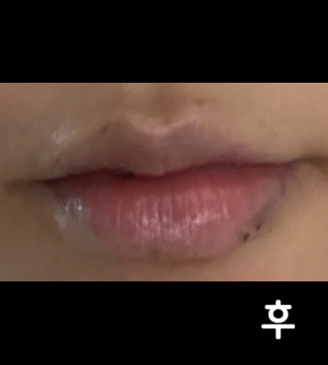 성형외과 피부과 많이 가봤지만 이렇게 친절하신 곳은 처음이에요..!! 오랜만에 맞은 건데 자연스럽게 잘 된 것 같아요 ㅠㅠ 감사합니다!!