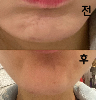 자갈턱 보톡스 맞았는데 꼼꼼하게 잘 놔주시고 멍도 하나도 안 들게 놔주셔서 넘 좋았어용ㅎㅎ 또 가려구용~