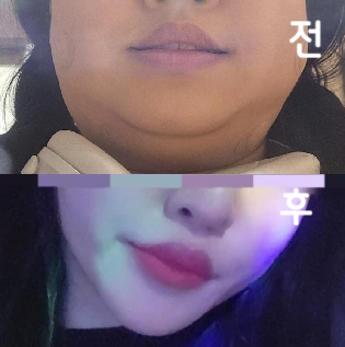 상담부터 시술과정까지 너무 남에 듭니당 지인분들에게도 강추해요 ㅎㅎ!!