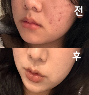 부작용이 조금 있었는데 사후 대처 잘 해주셔서 감사했습니다..!!