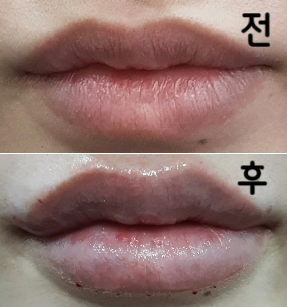 같은 가격 그대로 지금보다 더 좋은 시술을 제안해주셔서 대만족입니다!! 다음에 또 올게요~