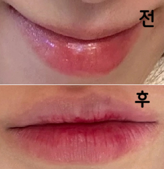 2주 정도 지나니까 붓기도 멍도 빠지고 자연스럽게 예뻐졌어요 ㅎㅎ