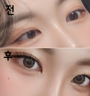 아무래도 눈 밑이라 멍도 심하게 들고 조금 아프긴 했지만 깔끔하게 잘 녹았고 금액적인 부분이나 친절하게 응대해주시는 점들이 좋았어요~!