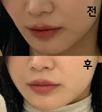 젊으신데도 불구하고 엄청 세심하게 잘 놔주셔서 좋았습니다!! 너무 친절하셔서 다음에도 또 맞으러 가고 싶어요!!