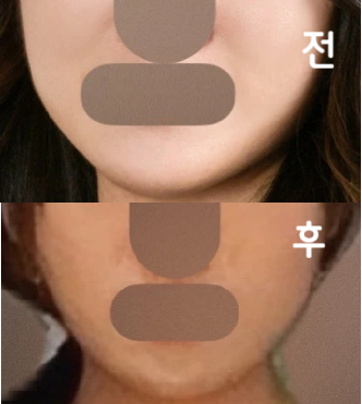 6시간밖에 안 지났는데 벌써 효과 나오는거 같은 기분은 뭘까 ㅋ!!!