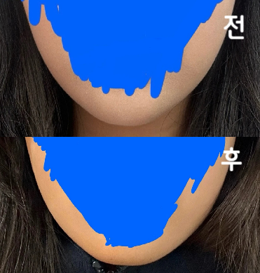 1달 좀 안됐을 때 얼굴살 확 빠졌다는 얘기 들었습니다!