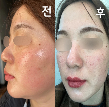 쥬베룩 포텐자 +2cc 신청했고 추가로 +2cc 진행했어요~ 스탭의 대응, 닥터의 정성스러운 시술이 너무 좋았습니다~!