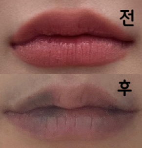 녹이는 주사 엄청 아프다그래서 진짜 걱정 많이 했는데 시술해주신 원장님이 안 아프게 정말 잘 해주신 것 같아요!!