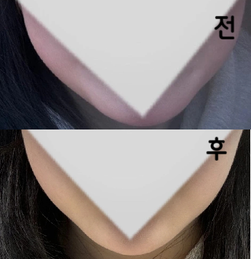 원장님께서 정말 친절하게 설명해주셔서 만족스러웠습니다! 열흘정도 됐는데 시간 지날수록 빠지는게 느껴져요~