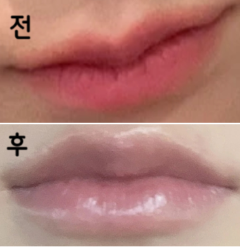 자연스럽게 하고 싶으신 분들은 1cc도 충분합니다! 저는 얇은 입술인데 총 0.7cc 넣었고 만족하고 있어요~~