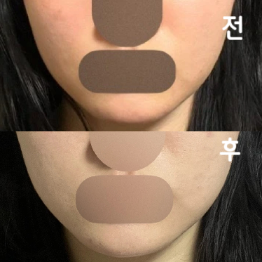 엄마가 갸름해졌대요~ 저는 땀 많이 나는 운동 일주일에 3-4번 병행했어요!