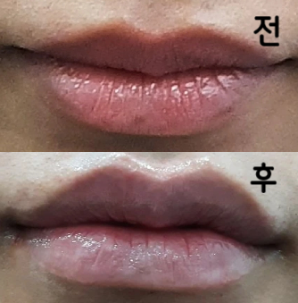 입꼬리보톡스와 입술필러 받았습니다! 스탭분들 상냥하고 업셀도 없어 안심하고 받을 수 있었어요~