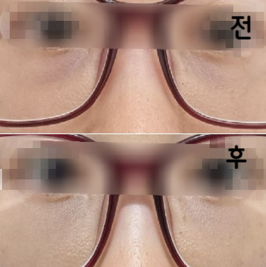 효과는 정말 좋았어요! 다크서클이 확실히 개선되었습니당!