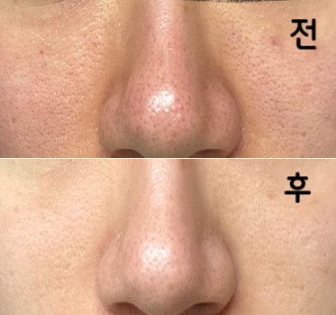 포텐자 풀페이스 +  쥬베룩 3cc (나비존+이마미간) 시술했어요~ 모공도 줄고 광도 점점 더 나는 것 같아요!