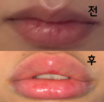 총 허벅지 2회 입술필러 맞았어요! 시술해주신 여자선생님 친절하셨구 2주 뒤 또 방문 예정입니다 ㅎㅎ
