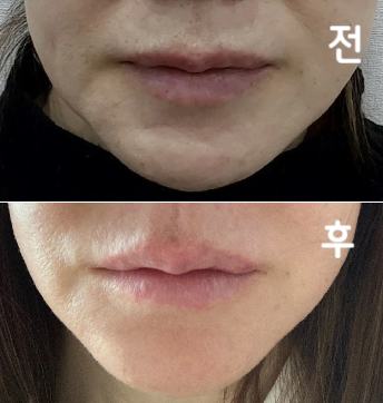 상담결과 슈링크, 팔자필러 진행했어요 결과적으로 매우 만족하고 있습니다!