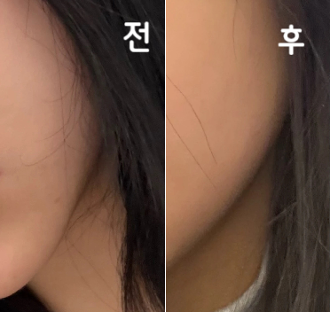 침샘이랑 같이 맞았고 시술 해주시는 직원분들 항상 친절하셔요~