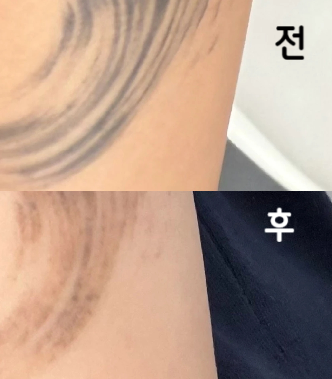 무난하게 받았어용 냉찜질 잘 하면 별루 안 아파용~