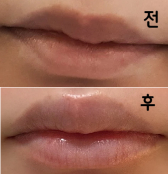 첫 입술필러와 입꼬리 보톡스였는데 대응, 가격, 마무리 모두 만족합니다!